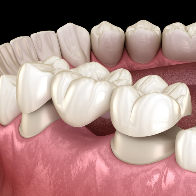 A dental bridge restoration.