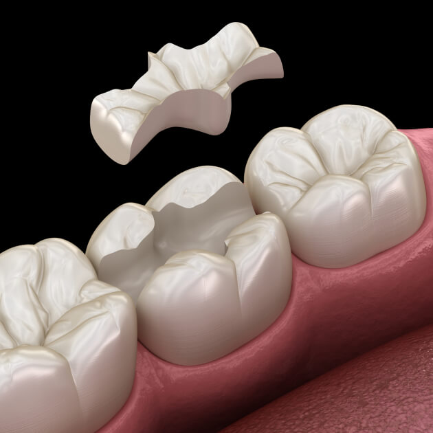 A dental restoration being placed on a damaged tooth.