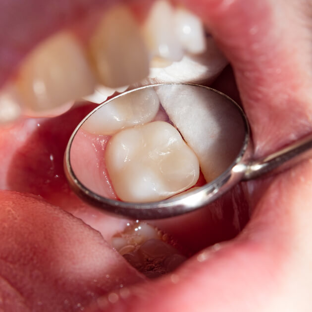 A dentist checking on a back molar in the mouth.